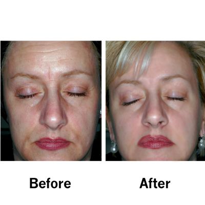 Before & After