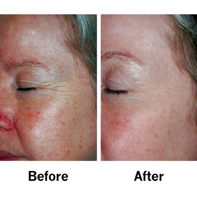 Before & After