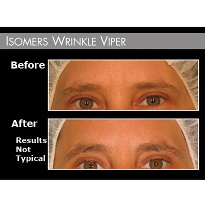 Before/After 2