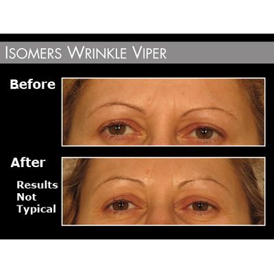 Before/After 3