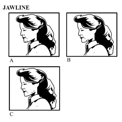 Unit Placement - Jawline