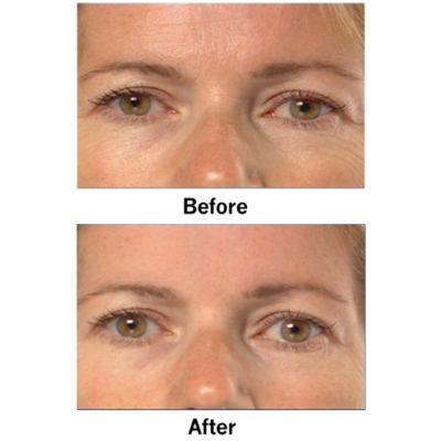 Before & After - Eyes